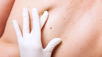 Sıradan bir ben melanoma dönüşür mü